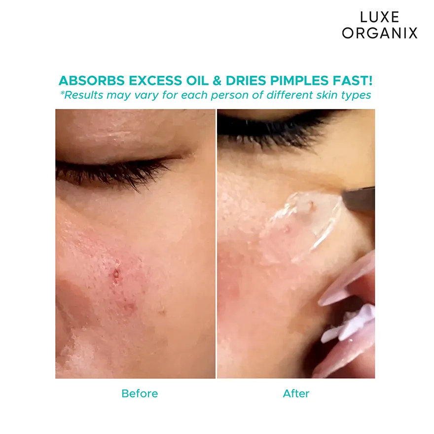 Luxe Organix Hydrocolloid Acne Patch Night Time 48s