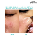 Luxe Organix Hydrocolloid Acne Patch Night Time 48s